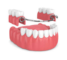 Next post 22 of the best ideas for summer birthday party favor ideas. Partial Dentures Costs Types Faqs Newmouth