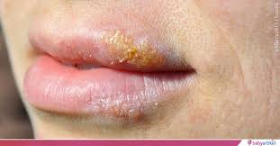 Herpes zoster only develops in people who have had chickenpox in the past. Achtung So Gefahrlich Ist Herpes Fur Dein Baby Babyartikel De Magazin