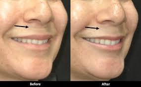 Results may last up to 2 years when treated. Filler Before And After Pictures Med Spa In Encino Ca A E Skin Professional