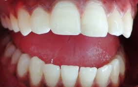 We did not find results for: Dental Filling And Tooth Cavity Filling Cost Treatment Causes