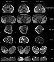 Posted by radiologyer at 8:12 am. Refining The Spinobulbar Muscular Atrophy Phenotype By Quantitative Mri And Clinical Assessments Neurology
