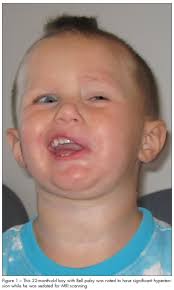 These are symptoms of bell's palsy. Hypertension In A Toddler With Bell Palsy Consultant360