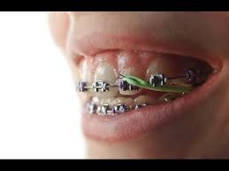 Elastic knee braces and supports can be a really helpful tool if you are suffering from knee pain. Rubber Bands For My Braces Do They Hurt Youtube