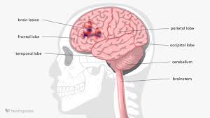 Image result for Brain Lesion