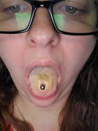 Is My Tongue Piercing Infected Please Help Piercing
