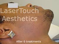 To prevent razor bumps and ingrown hair, it is important to preserve the sharpness of the blades by declogging the razor every time you use it. Laser Ingrown Hair Beard Razor Bump Removal New York City Manhattan