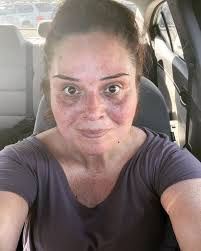 HW: 300 SW: 264 CW: 206 GW: 150 I had the gastric sleeve 3 months ago. I  feel great! But the roll that makes my clothes look horrible and the turkey  neck