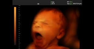 Ist ultraschall in der schwangerschaft gefährlich? Babywatching Das Betrachten Des Feten Mit Ultraschall