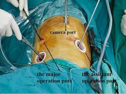 Pulmonary complications and anastomotic leaks are the leading causes of postoperative mortality after esophagectomy. Laparoscopic And Thoracoscopic Esophagectomy With Intrathoracic Anastomosis For Middle Or Lower Esophageal Carcinoma Abstract Europe Pmc
