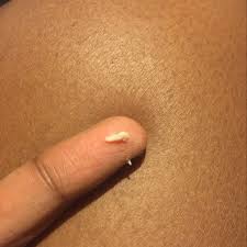 How long does a yeast infection last without treatment. Examining Myself And I See This Clump What Are The Possibilities I Also See Clumps After I Pee Possible Yeast Infection Could I Use Monistat And Rephresh Gel I Ve Never Had This