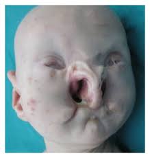 Do not show anomaly's face. The Bps Patient Closeup Of Face Showing Severe Craniofacial Anomalies Download Scientific Diagram
