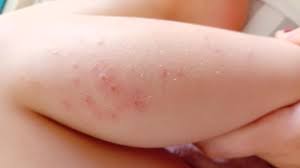 Image result for vyrážka u dětí