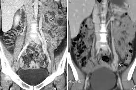 Pelvic Congestion Syndrome The Role Of Interventional Radiology In The Treatment Of Chronic Pelvic Pain Postgraduate Medical Journal