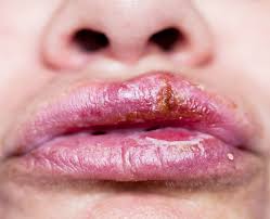 Image result for Oral herpes roof of mouth