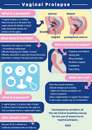 Image result for Pessary