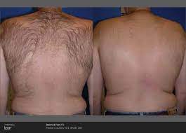 Keep in mind that these laser hair removal prices are per session. Laser Hair Removal Ocala The Villages Fl