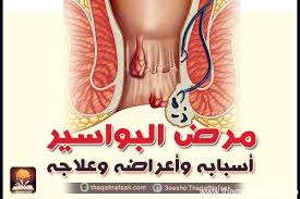 وداعا للبواسير والشرخ الشرجي والناسور فقط في ٣ ايام publications facebook