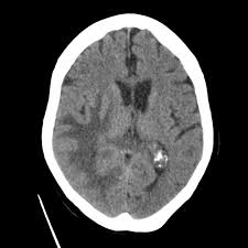 Metastatic breast cancer is essentially stage iv breast cancer. Brain Metastases From Breast Cancer Radiology Case Radiopaedia Org