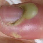 Image result for phlegmon of hand)