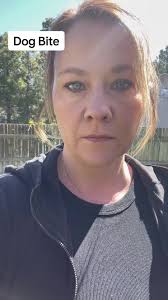 What would you have done? #dogbite #rover