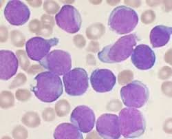 Nearly all women diagnosed with this. Cancer Out Of Control Cells