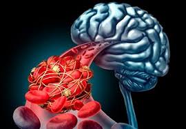 Existem diferentes tipos de aneurisma, dependendo da localização em que eles são formados. Aneurisma Cerebral Descubra Os Sintomas E Como Tratar Dr Rocha