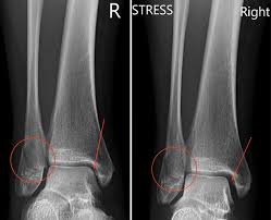 Image result for Ankle XRay