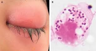 Image result for Gonococcal Conjunctivitis