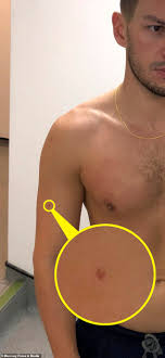 مش كله لعب وهرى تطبيق على الهاتف يكشف إصابة بريطانى بسرطان الجلد صور اليوم السابع