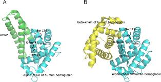 Sickle thalassemia results from the inheritance of one β s gene and a thalassemia defect on the other β gene. A Thalassemia Associated With Hb Instability A Tale Of Two Features The Case Of Hb Rogliano Or A1 Cod 108 G15 Thr Asn And Hb Policoro Or A2 Cod 124 H7 Ser Pro