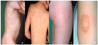Image result for Urticaria pigmentosa children