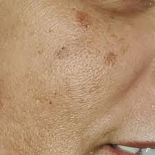 Beauty get the tlc you need. Teatrical Gen00881 Skin Lightening Cream Night Time Dark Spot Remover 1 7oz For Sale Online Ebay