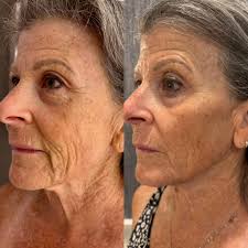 Who takes a collagen supplement here?