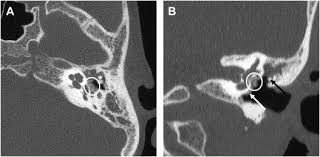 Image result for Myringosclerosis