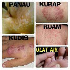 Panu merupakan salah satu penyakit kulit paling umum yang diderita banyak orang. Set Sabun Krim Daun Gelenggang 4x Lulur Kunyit Utk Panau Parut Kudis Kurap Shopee Malaysia