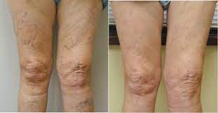 10 Off Cosmetic Sclerotherapy For Spider Veins Call For An Appointment Sclerotherapy Vein Specialist Veins Treatment