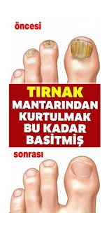 Tirnak Mantarindan Kurtulmanin En Pratik Yolu