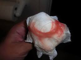 Check spelling or type a new query. Mucus Plug What Does A Mucus Plug Look Like Practical Parenting Australia