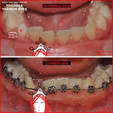 Prenses Yagmur Ates Dr Yalcin Ergir