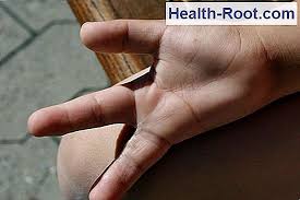 Dette er når hjertet slår veldig fort (selv når du sitter. Typer Av Atrieflimmer Sykdom Symptomer Behandlings 2021