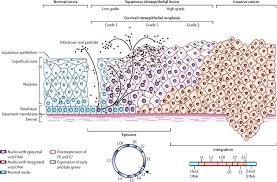 Screening tests can find precancerous polyps, so they can be removed before they turn into cancer. Cervical Cancer The Lancet
