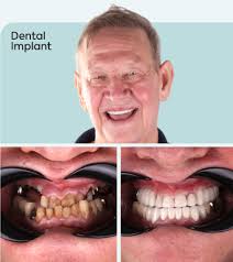 Dental Implants Turkey