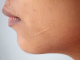 However, these types of scars occur more often, don't get as big as keloids. Keloids Hypertrophic Scars Dermatology Sydney
