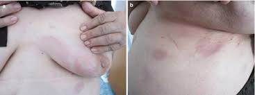 Image result for zoster under breasts