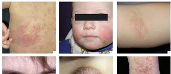 Image result for dermatitis contacta children