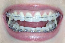 Because You Had To Remember To Change Your Rubber Bands After Every Meal Getting Braces Teeth Braces Cute Braces