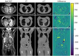 Artificial Intelligence-driven PET/MRI Imaging | Emory School of Medicine