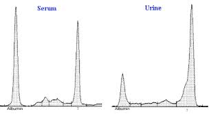 Multiple myeloma diagnosis test principle. Total Protein Electrophoresis Cornell University College Of Veterinary Medicine