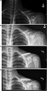 Image result for Fracture Complication