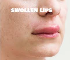 Top Home Remedies For Swollen Lips Allergy Healthphreaks Lip Allergy Swollen Lips Swollen Lip Remedy